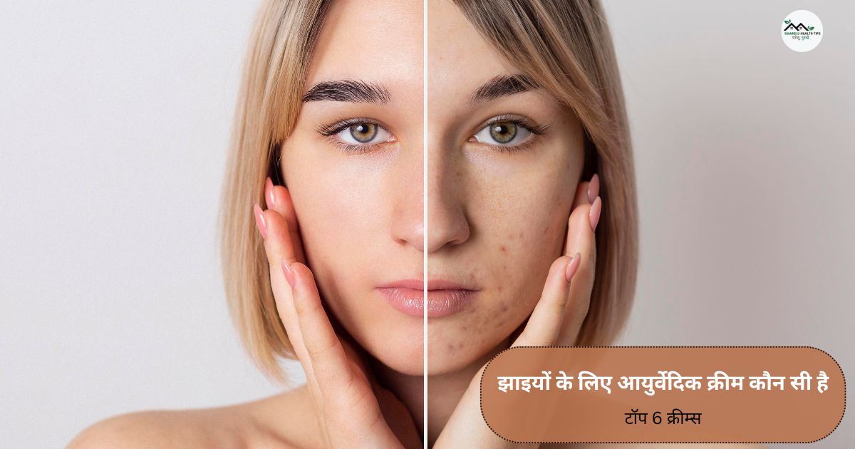 झाइयों के लिए आयुर्वेदिक क्रीम कौन सी है