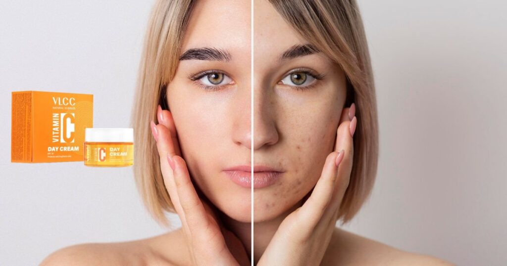 झाइयों के लिए आयुर्वेदिक क्रीम कौन सी है? Top 6 क्रीम्स 8 झाइयों के लिए आयुर्वेदिक क्रीम कौन सी है? Top 6 क्रीम्स