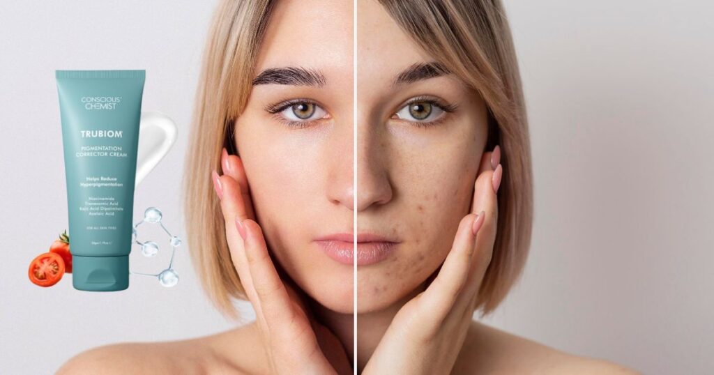 झाइयों के लिए आयुर्वेदिक क्रीम कौन सी है? Top 6 क्रीम्स 9 झाइयों के लिए आयुर्वेदिक क्रीम कौन सी है