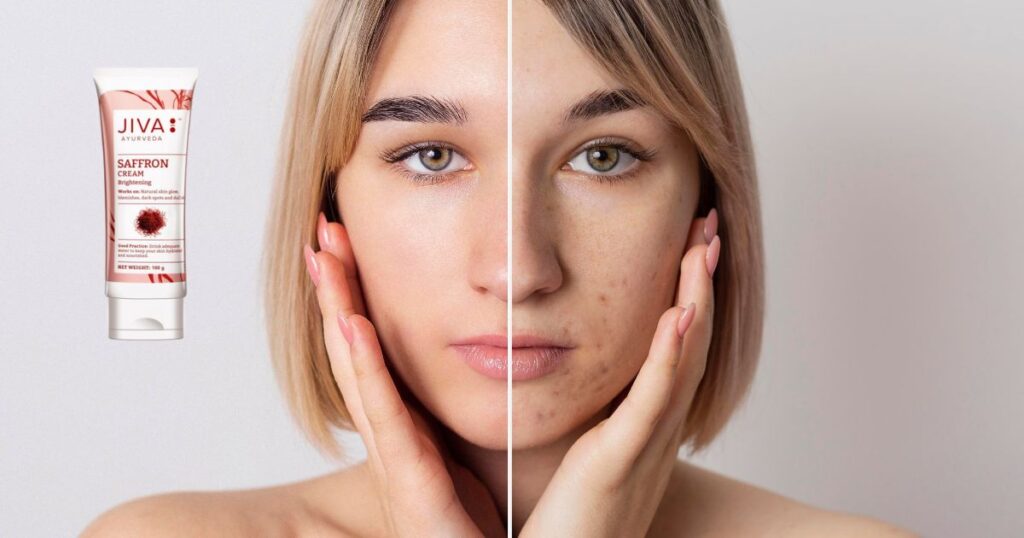 झाइयों के लिए आयुर्वेदिक क्रीम कौन सी है? Top 6 क्रीम्स 6 Jhaiyon Ko Hatane Wali Cream