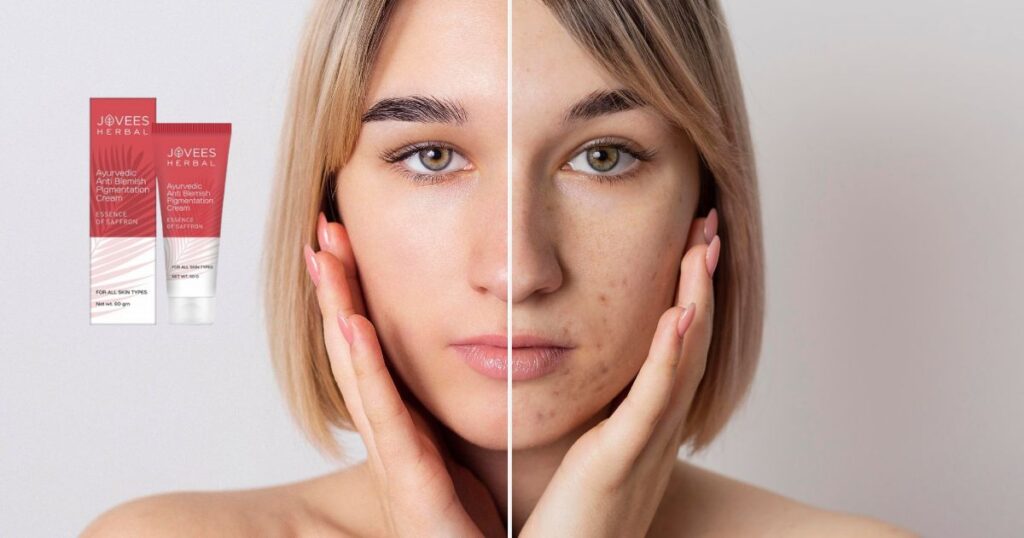 झाइयों के लिए आयुर्वेदिक क्रीम कौन सी है? Top 6 क्रीम्स 4 Jhaiyon Ko Hatane Wali Cream