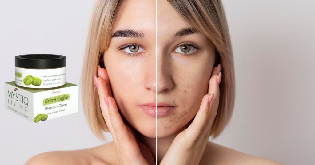 झाइयों के लिए आयुर्वेदिक क्रीम कौन सी है? Top 6 क्रीम्स 7 झाइयों के लिए आयुर्वेदिक क्रीम कौन सी है? Top 6 क्रीम्स